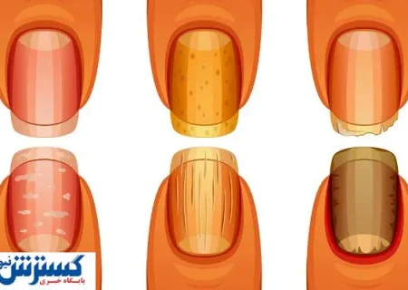 تشخیص سرطان ریه از روی ناخن ممکن شد